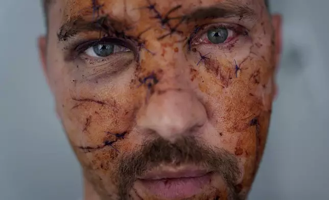 Multiple wounds cover the face of Kostiantyn Bychek, 35, after he was injured in a Thursday Russian strike on residential neighborhood, as he visits a hospital in Kyiv, Ukraine, on Friday, April 25, 2025. (AP Photo/Evgeniy Maloletka)