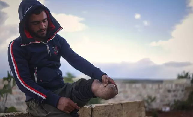 Shepherd Jalal Ma'rouf, 22, shows the stump of the limb he lost to a landmine while herding sheep in farmland recently recaptured from regime forces, at his home in Deir Sunbul village, south of Idlib, Wednesday, April 9, 2025. (AP Photo/Ghaith Alsayed)