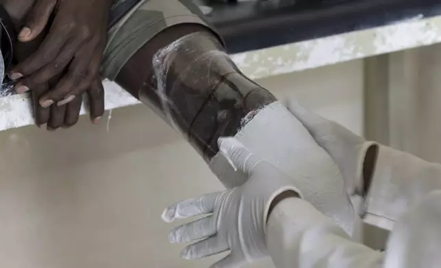 A doctor examines a man with a prosthetic leg at Ortho-Physiotherapy Centre in Mekele, Tigray region of northern Ethiopia Friday, Feb. 14, 2025. (AP Photo/Amanuel Birhane)