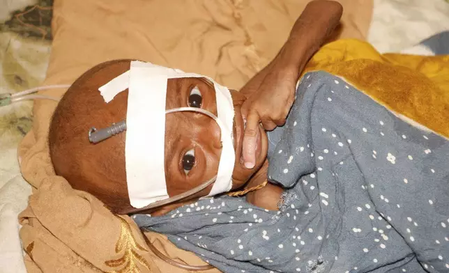A Malnourished child receives treatment at Banadir Hospital in Mogadishu, Somalia, Wednesday, May 14, 2025. (AP Photo/Farah Abdi Warsameh)
