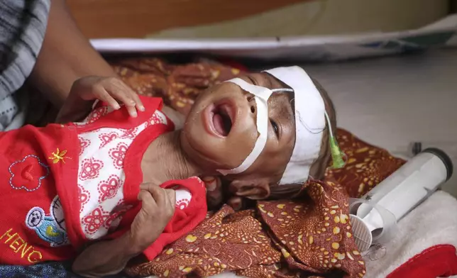 A Malnourished child receives treatment at Banadir Hospital in Mogadishu, Somalia, Wednesday, May 14, 2025. (AP Photo/Farah Abdi Warsameh)