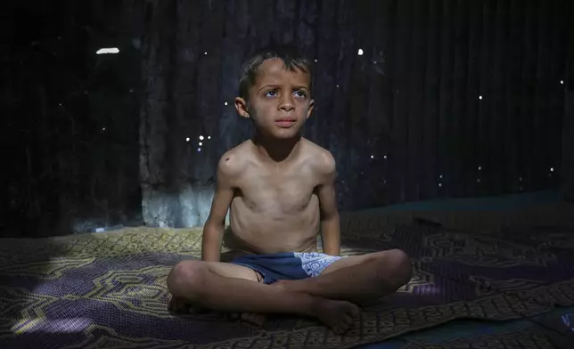Ahmed El-Sheikh Eid, 7, who shows signs of malnutrition, poses for a photo at his family tent at a camp for displaced Palestinians in Mawasi Khan Younis, Gaza Strip, Friday, May 2, 2025. (AP Photo/Abdel Kareem Hana)