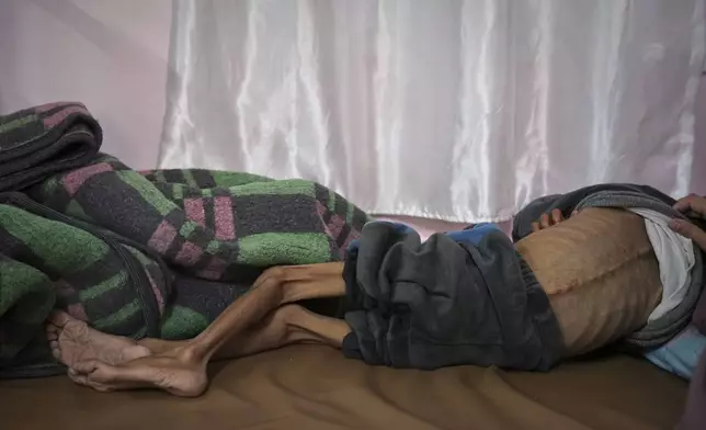 Mona al-Raqab lifts the shirt of her 5-year-old son, Osama al-Raqab, revealing signs of malnutrition and worsening cystic fibrosis, exacerbated since the start of the war by the shortage of meat, fish, and enzyme tablets needed to help him digest food, as he receives treatment at the malnutrition clinic in Nasser hospital, Khan Younis, Gaza Strip, Thursday, May 1, 2025(AP Photo/Abdel Kareem Hana)