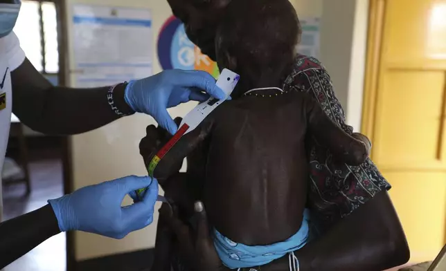 Sunday Achok, 14 months old, who suffers acute malnutrition and complications, is measured at the Ammusait General Hospital in Turkana, Kenya Wednesday, June 4, 2025. (AP Photo/Andrew Kasuku)