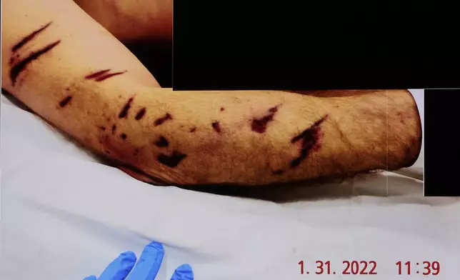 A photograph of John O'Keefe's right arm is republished during the murder retrial of Karen Read in Norfolk Superior Court, Monday, June 2, 2025, in Dedham, Mass. (Pat Greenhouse/The Boston Globe via AP, Pool)