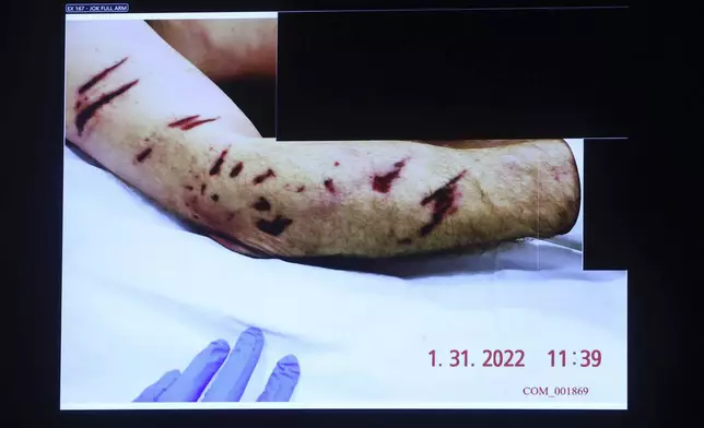 Autopsy photo of the injured arm of deceased Boston Police Officer John O'Keefe during the Karen Read retrial, Tuesday, June 10, 2025, in Dedham, Mass. (Matt Stone/The Boston Herald via AP, Pool)