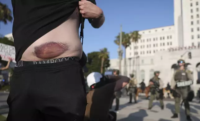 A protester displays their injury from a less-lethal round from several days ago during a protest outside City Hall on Wednesday, June 11, 2025, in Los Angeles. (AP Photo/Ethan Swope)