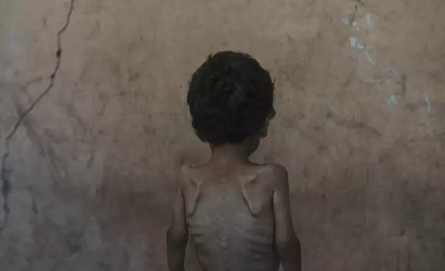 Yazan Abu Ful, a 2-year-old malnourished child, poses for a photo at his family home in Shati refugee camp in Gaza City on Wednesday, July 23, 2025. (AP Photo/Jehad Alshrafi)