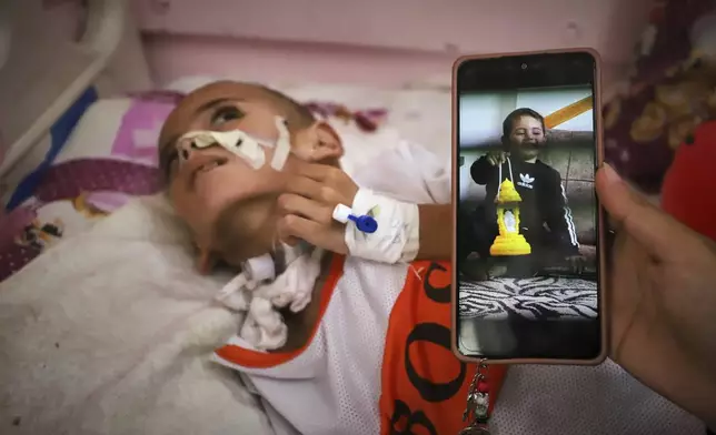 An old photo of 3-year-old Amr al-Hams is displayed on a phone as he lies in a hospital bed with brain damage caused by an Israeli strike on his family's tent in April, at Nasser Hospital in Khan Younis, Gaza Strip, Wednesday, June 25, 2025. (AP Photo/Mariam Dagga)