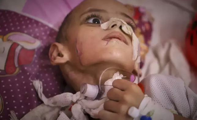 Three-year-old Amr al-Hams, who has brain damage caused by an Israeli strike on his family's tent in April, lies in a bed at Nasser Hospital in Khan Younis, Gaza Strip, Wednesday, June 25, 2025. (AP Photo/Mariam Dagga)