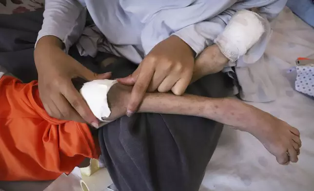 Nour al-Hams cares for her 3-year-old nephew, Amr al-Hams, who lies in a hospital bed with brain damage caused by an Israeli strike on his family's tent in April, at Nasser Hospital in Khan Younis, Gaza Strip, Wednesday, June 25, 2025. (AP Photo/Mariam Dagga)