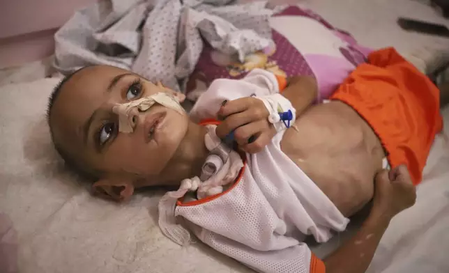 Three-year-old Amr al-Hams, who has brain damage caused by an Israeli strike on his family's tent in April, lies in a bed at Nasser Hospital in Khan Younis, Gaza Strip, Wednesday, June 25, 2025. (AP Photo/Mariam Dagga)