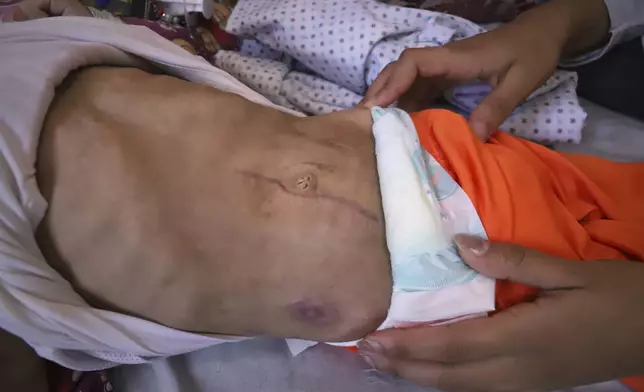 Nour al-Hams cares for her 3-year-old nephew, Amr al-Hams, who lies in a hospital bed with brain damage caused by an Israeli strike on his family's tent in April, at Nasser Hospital in Khan Younis, Gaza Strip, Wednesday, June 25, 2025. (AP Photo/Mariam Dagga)