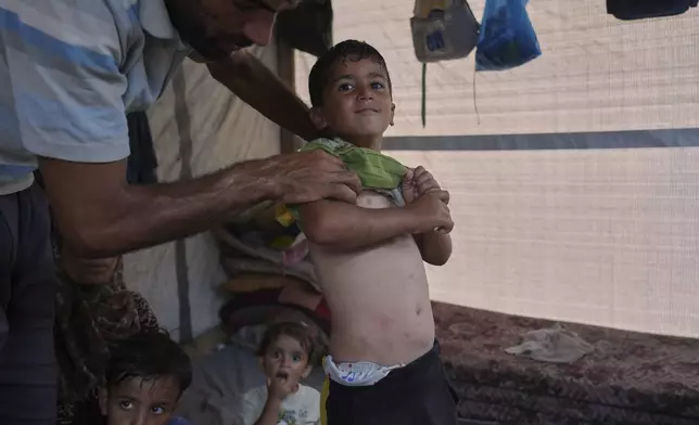 Muhammad Abu Hadayed, 33, shows skin rashes suffered by his 7-year-old son Adam as they stand in their tent at a camp for displaced people in Khan Younis, southern Gaza Strip, Tuesday, July 1, 2025. (AP Photo/Abdel Kareem Hana)