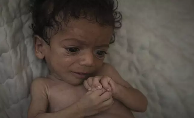 Seven-month-old Salem Awad, suffering from severe malnutrition, lies on a mattress in his family's tent in Gaza City, July 28, 2025. (AP Photo/Jehad Alshrafi)