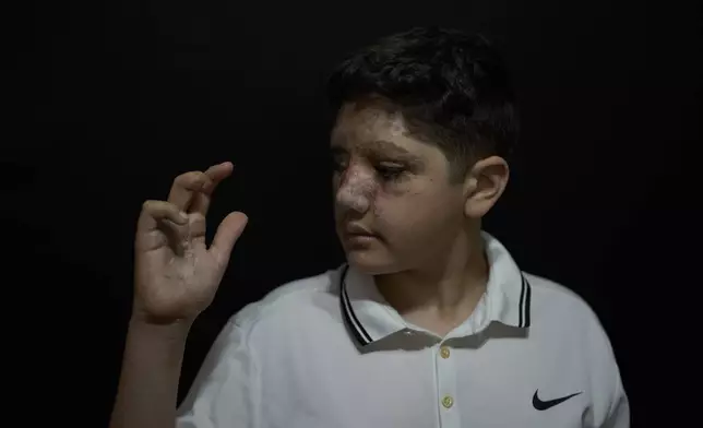 Ali Abbas, 11, who was wounded in the pagers attack carried out by Israel on September 17, 2024, shows his wounded hand as he poses for a photograph in the southern village of Barish, Lebanon, Monday, April 28, 2025. (AP Photo/Hassan Ammar)