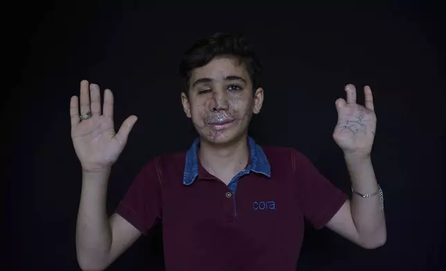 Hussein Dheini, 12, who was wounded in the pagers attack carried out by Israel on September 17, 2024, shows his wounded hand as he poses for a photograph in the southern village of Teir Debba, Lebanon, Thursday, May 1, 2025. (AP Photo/Hassan Ammar)