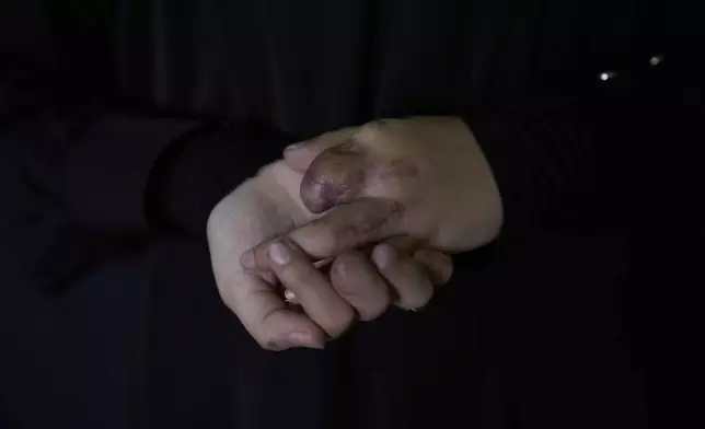 Sarah Jaffal, 21, who was wounded in the pagers attack carried out by Israel on September 17, 2024, shows her wounded hand as he poses for a photograph in the southern village of Bazourieh, Lebanon, Thursday, May 1, 2025. (AP Photo/Hassan Ammar)