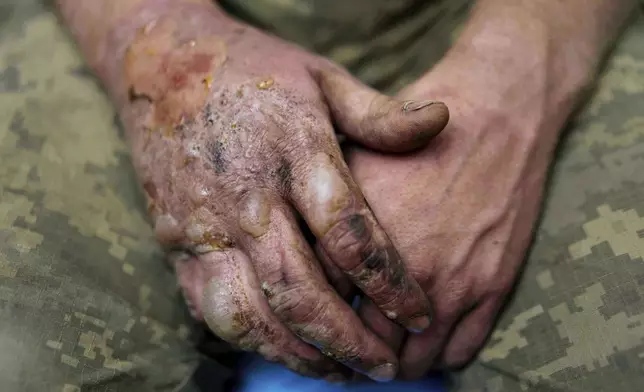 Burns are seen on the hands of a Ukrainian soldier of Da Vinci Wolves Battalion who was injured during fighting with Russian forces at the front line on Pokrovsk direction, Ukraine, on Sunday, Aug. 10, 2025. (AP Photo/Evgeniy Maloletka)