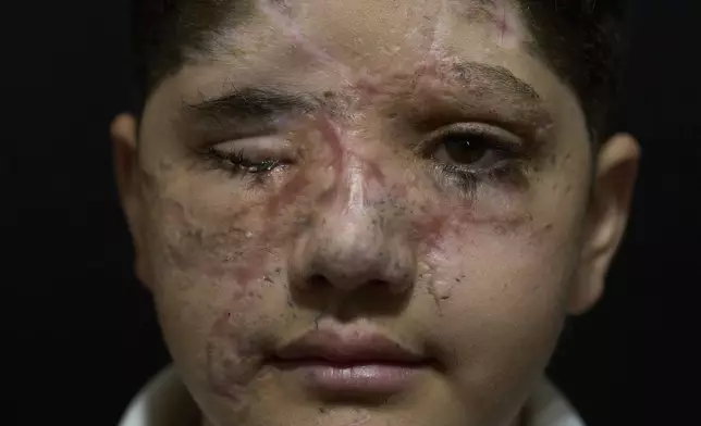 Ali Abbas, 11, who was wounded in the pagers attack carried out by Israel on September 17, 2024, poses for a photograph in the southern village of Barish, Lebanon, April 28, 2025. (AP Photo/Hassan Ammar)