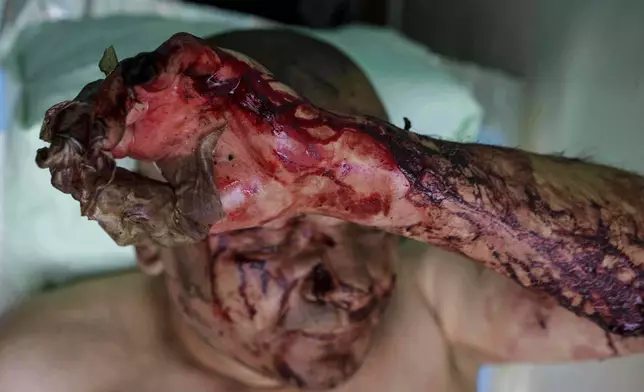 EDS NOTE: GRAPHIC CONTENT - Burns on the face and hand of a Ukrainian soldier who was injured during fighting with Russian forces on the front line, at stabilization point of Da Vinci Wolves Battalion on Pokrovsk direction, Ukraine, on Monday, Aug. 11, 2025. (AP Photo/Evgeniy Maloletka)