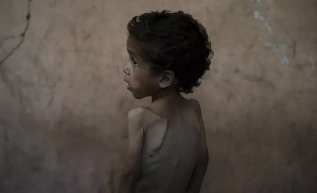 Yazan Abu Ful, a 2-year-old malnourished boy, stands shirtless for a photo at his family's home in the Shati refugee camp in Gaza City, Wednesday, July 23, 2025. In Gaza, malnutrition is often worsened by preexisting conditions and compounded by illnesses linked to inadequate health care and poor sanitation, largely the result of the ongoing war. (AP Photo/Jehad Alshrafi)