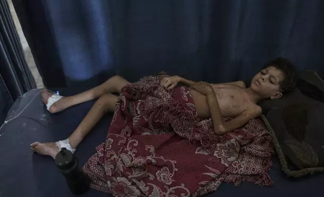 Saif Hijazi, 13, who suffers from severe malnutrition and was partially paralyzed by shelling lies on a bed to have his picture taken at the Shifa Hospital where he is being treated in Gaza City, Monday, July 28, 2025. In Gaza, malnutrition is often worsened by preexisting conditions and compounded by illnesses linked to inadequate health care and poor sanitation, largely the result of the ongoing war. (AP Photo/Jehad Alshrafi)