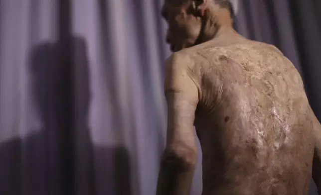 FILE - Sumiteru Taniguchi, a survivor of the 1945 atomic bombing of Nagasaki, shows scars on his back during an interview at his office in Nagasaki, southern Japan, June 30, 2015. (AP Photo/Eugene Hoshiko, File)