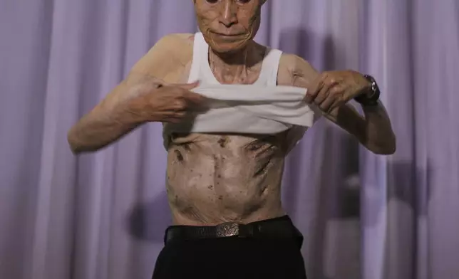 Sumiteru Taniguchi, a survivor of the 1945 atomic bombing of Nagasaki, removes his clothing to show the scars on his body during an interview at his office in Nagasaki, southern Japan, June 30, 2015. (AP Photo/Eugene Hoshiko)