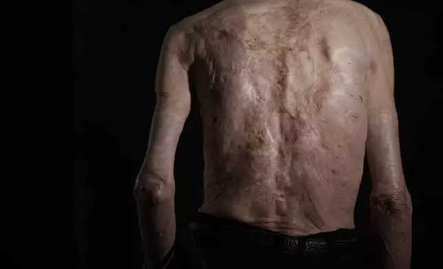 FILE - Sumiteru Taniguchi, 86, a survivor of the 1945 atomic bombing of Nagasaki, shows burn scars on his back during an interview at his office in Nagasaki, southern Japan, June 30, 2015. (AP Photo/Eugene Hoshiko)
