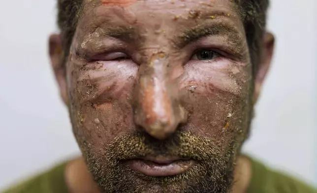 Burns cover the face of Artem aka "Lisnyk," a Ukrainian soldier from the Da Vinci Wolves Battalion who was injured during fighting with Russian forces on the Pokrovsk front, Aug. 10, 2025. (AP Photo/Evgeniy Maloletka)