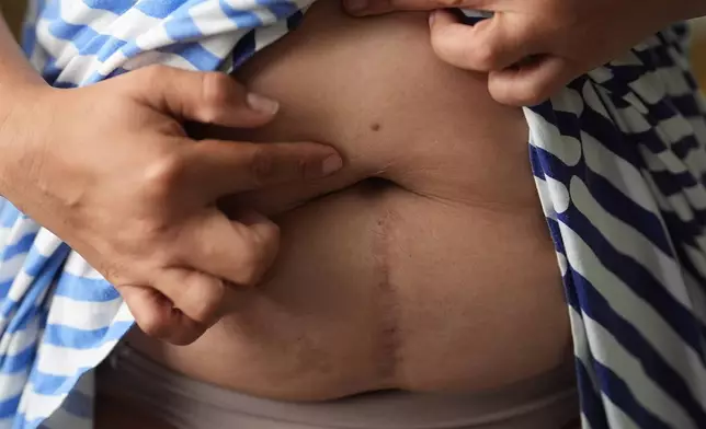 Colombian asylum-seeker Paola Freites, 37, who asked to be identified by her middle name and second last name to protect her family's safety, points to scars left by a brutal gang rape and torture she suffered at the age of 13, in which her attackers left her for dead after cutting her abdomen open, Thursday, Aug. 21, 2025, in Apopka, Fla. (AP Photo/Rebecca Blackwell)