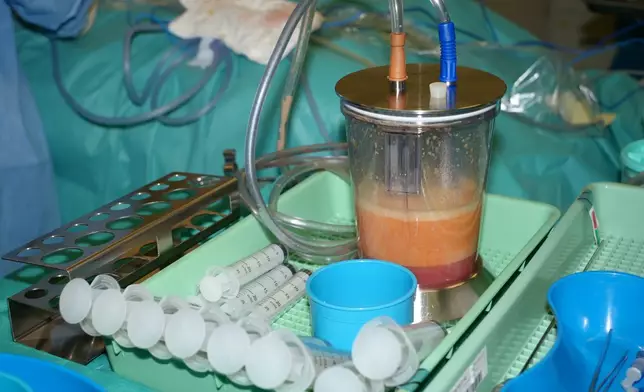 The trial integrates immediate lipofilling into breast-conserving surgery to reconstruct the breast. This technique involves harvesting the patients’ own fat from areas with higher fat deposits, processing it and then injecting it into the breast.