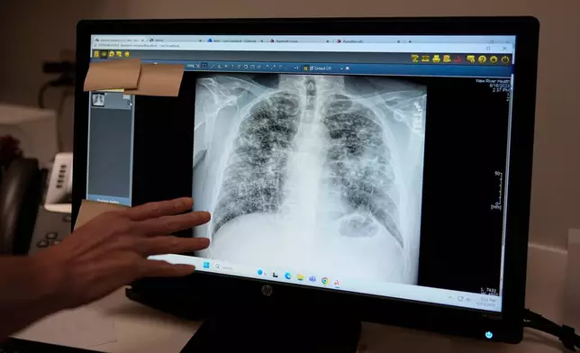 Lisa Emery, director of the New River Health Association Black Lung Clinic, examines a chest X-ray showing progressive massive fibrosis, the most complicated form of black lung, at the center on Sept. 23, 2025, in Oak Hill, W.Va. (AP Photo/Carolyn Kaster)