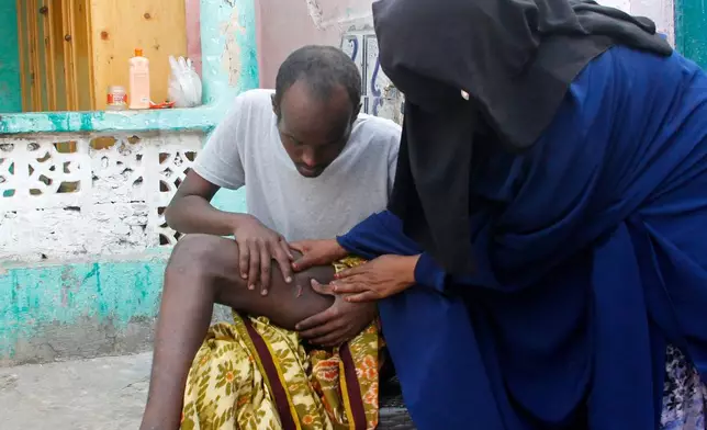 Mohamed Abdi Awale, who says he was captured and tortured by smugglers while attempting to reach Europe, shows his mother wounds during an interview with The Associated Press in Mogadishu, Somalia, Monday, Nov. 17, 2025. (AP Photo/Farah Abdi Warsameh)