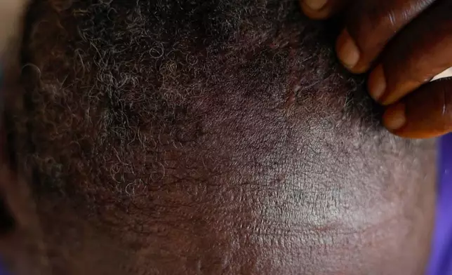 Satta Surtual shows a scar from an injury sustained during a protest in Gogioma, Liberia, July 9, 2025. (AP Photo/Misper Apawu)