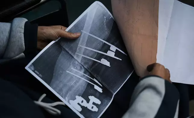 Islam Saleh, who was injured in her left leg in an Israeli strike on a school shelter in Jabalia in 2024, shows her medical reports inside her family's tent in Zawaida, Gaza Strip, Tuesday, Jan. 27, 2026, as she awaits permission to travel outside Gaza for treatment. (AP Photo/Abdel Kareem Hana)