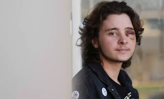 Kaden Rummler, who was injured after being hit with a projectile fired by a federal agent during a protest outside an immigration building in Santa Ana, Calif., poses for a portrait Wednesday, Jan. 14, 2026, in Southern California. (AP Photo/Damian Dovarganes)