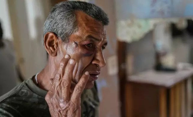 Wilman Gonzalez shows an injury he says he suffered when his home was hit during U.S. military operations to capture Venezuelan President Nicolas Maduro, in Catia La Mar, Venezuela, Sunday, Jan. 4, 2026. (AP Photo/Matias Delacroix)