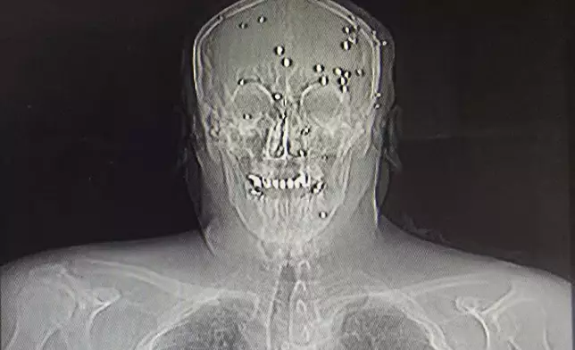 This is a photo of an X-ray image taken Jan. 9, 2026, obtained outside Iran, showing an Iranian protester who was hit in the face by pellets in Rasht, northern Iran. (UGC via AP)