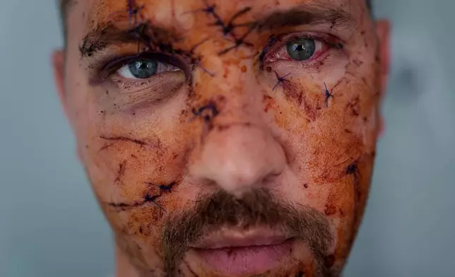 FILE - Multiple wounds cover the face of Kostiantyn Bychek after he was injured in a Russian strike on residential neighborhood, during a hospital visit in Kyiv, Ukraine, April 25, 2025. (AP Photo/Evgeniy Maloletka, File)