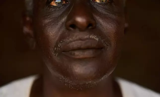 FILE - Abbas Awad, who has glaucoma, poses for a portrait at his home in Qoz Nafisa village, Sudan, April 22, 2026. (AP Photo/Bernat Armangue, File)