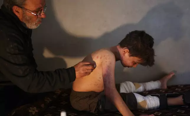 Mohammad al-Suwadi, cleans the wounded back of his son Ibrahim al-Suwadi, 10, injured last month in a landmine explosion while playing with his friends near the village school, at their home in the town of al-Habit in southern Idlib countryside, Thursday, May 21, 2026, (AP Photo/Ghaith Alsayed)