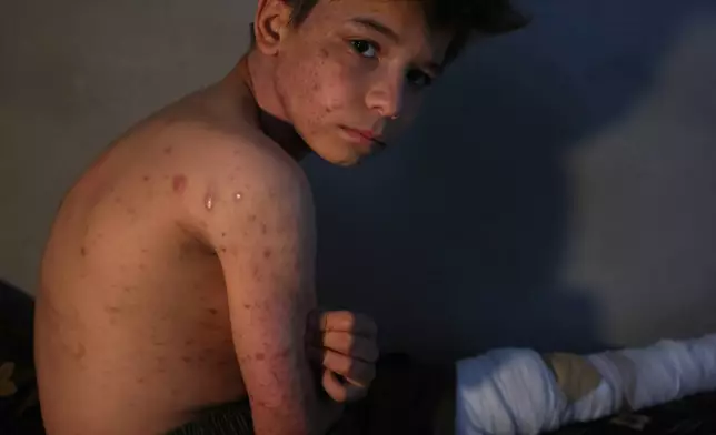 Ibrahim al-Suwadi, 10, who was injured last month in a landmine explosion while playing with friends near the village school, sits on his bed at his home in the town of al-Habit in southern Idlib countryside, Thursday, May 21, 2026. (AP Photo/Ghaith Alsayed)