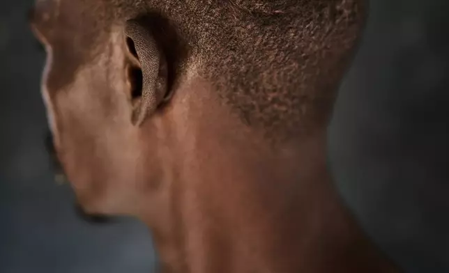 FILE - Hussein Mohamed Shareef shows the scar on his head where he said an RSF sniper shot him in Omdurman, as he poses for a photo at the Al Heshan camp for internally displaced people in Port Sudan, Sudan, Wednesday, April 15, 2026. (AP Photo/Bernat Armangue, File)