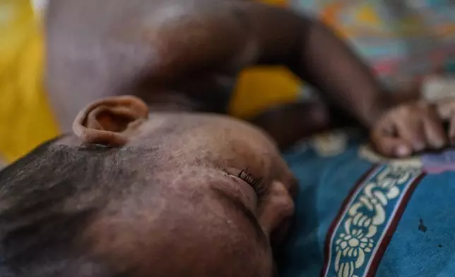 A child rests as he receives treatment during a measles outbreak in a hospital in Dhaka, Bangladesh, Tuesday, Sept. 8, 2026. (AP Photo/Mahmud Hossain Opu)
