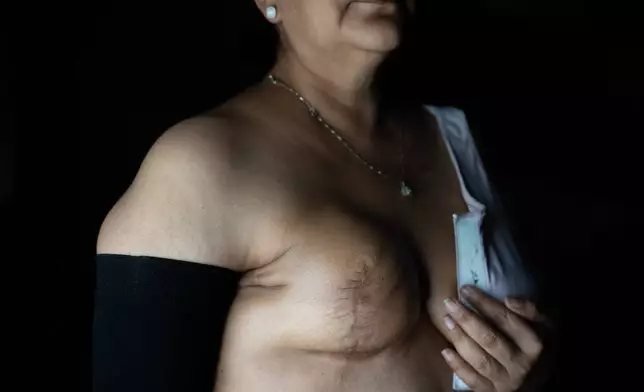 EDS NOTE: NUDITY - Cindy Banda shows her mastectomy scar, Sept. 16, 2026, at her home in McAllen, Texas. (AP Photo/Julia Demaree Nikhinson)