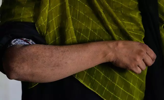 A factory worker shows her arm with damage she believes to be from routine chemical exposure in Karachi, Pakistan, Sunday, Oct. 4, 2026. (AP Photo/Anjum Naveed)