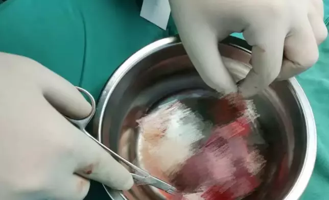 剛滿月男嬰剖腹誕下「寄生胎」。網上圖片