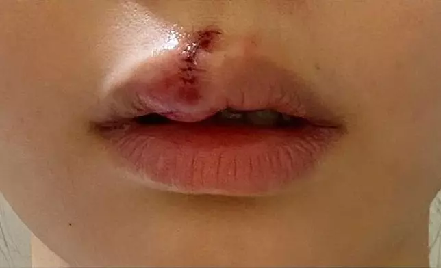 Aka剛被狗咬的傷痕。（資料圖片）